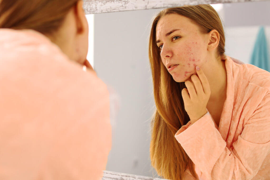 Wie heeft er last van acne?