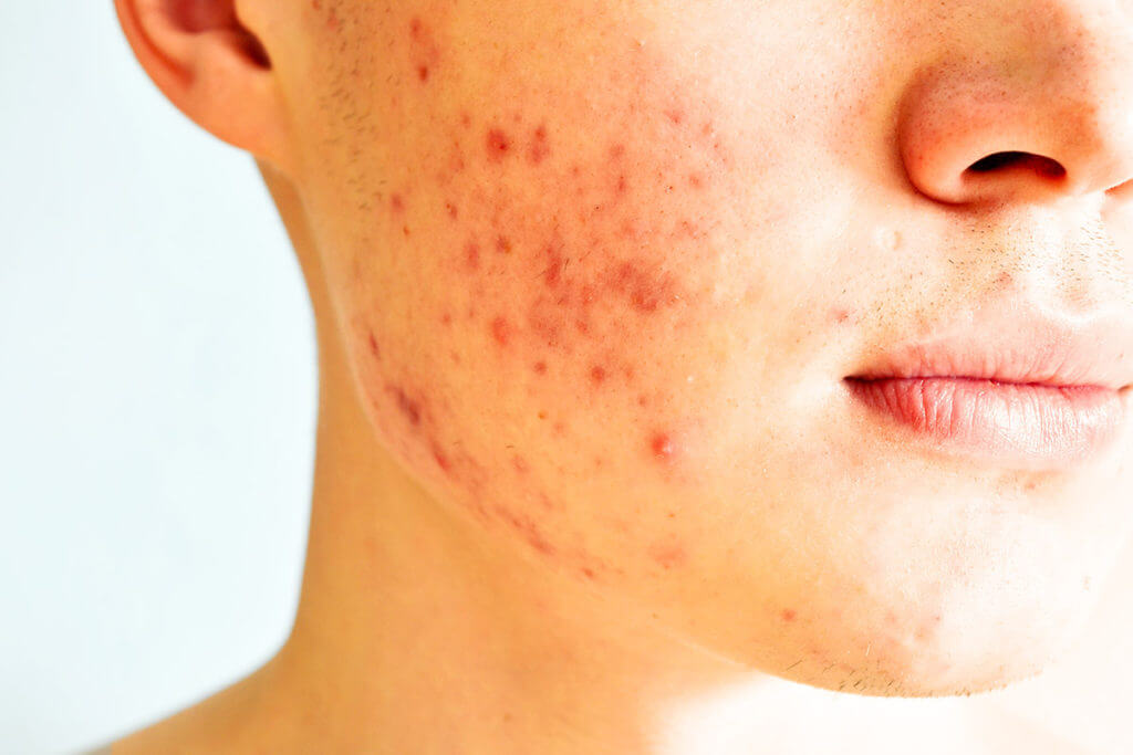 Typical symptoms of acne