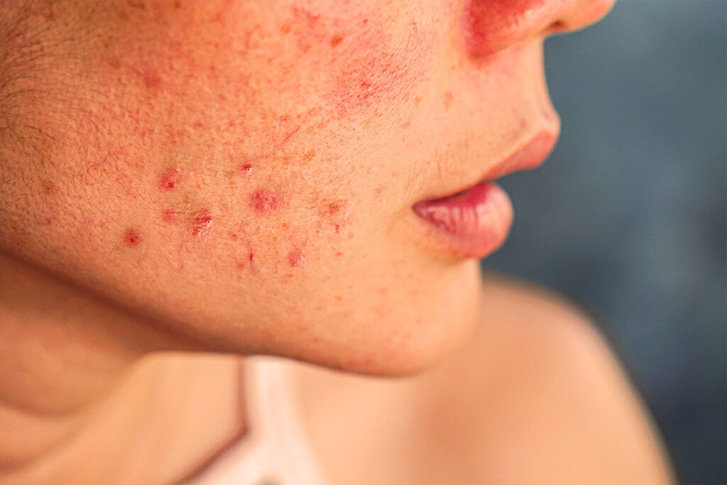 What is my body missing with acne?