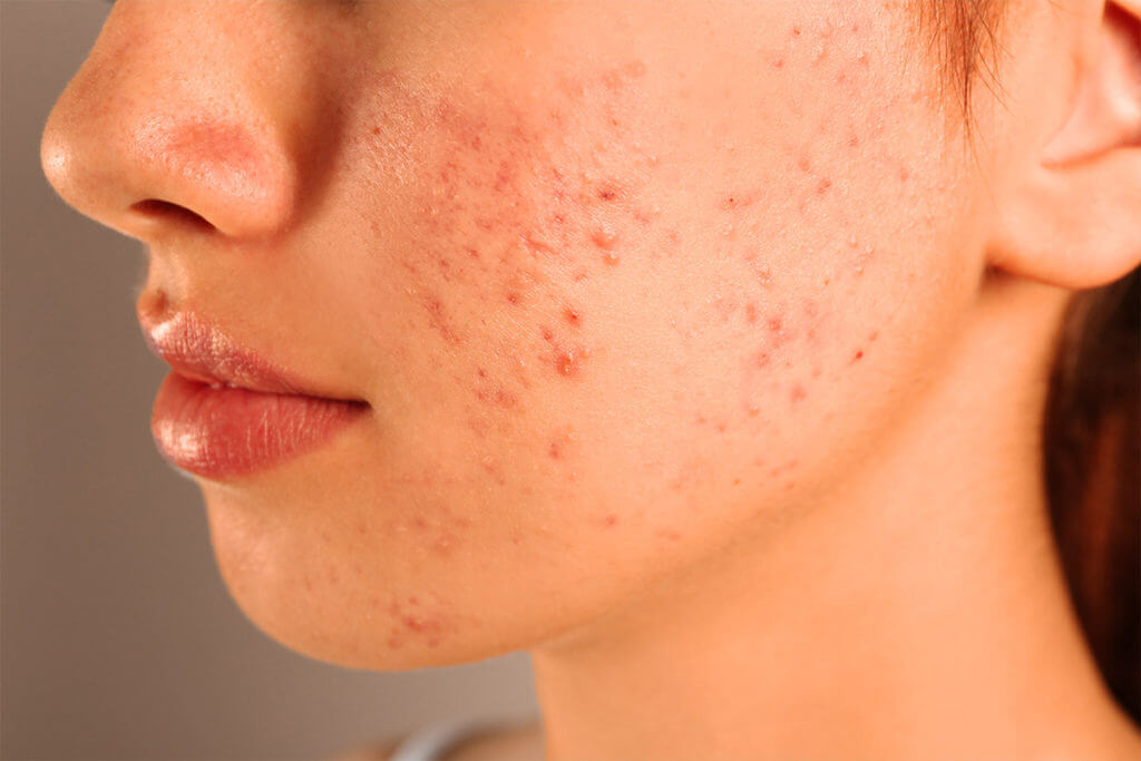 Acne - Wat is acne precies en wat is de oorzaak?