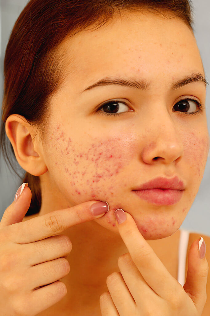 Traitement de l'acné - médicaments et thérapie alternative