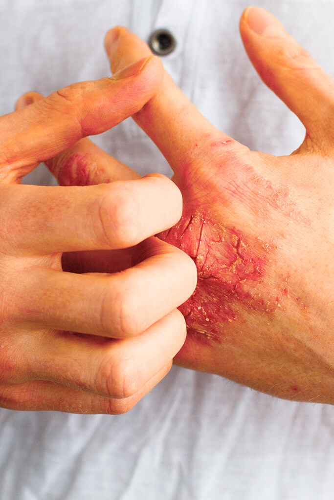 Using bacteriophages against neurodermatitis