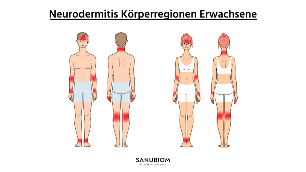 Parmi les zones du corps qui sont typiquement touchées par la dermatite atopique, on trouve le visage, les yeux, le front et le cou, ainsi que l'intérieur des articulations.
