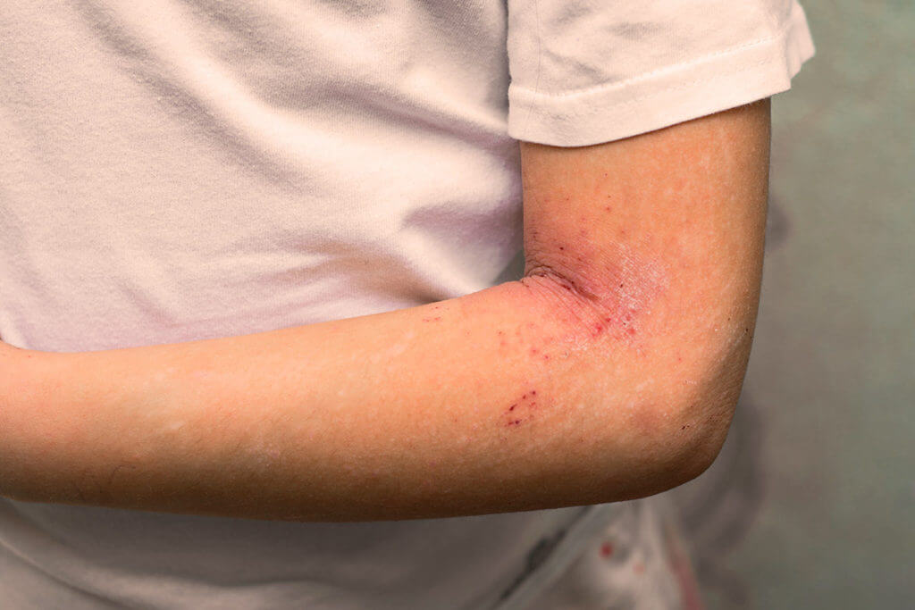 Symptômes de la dermatite atopique chez les bébés et les jeunes enfants