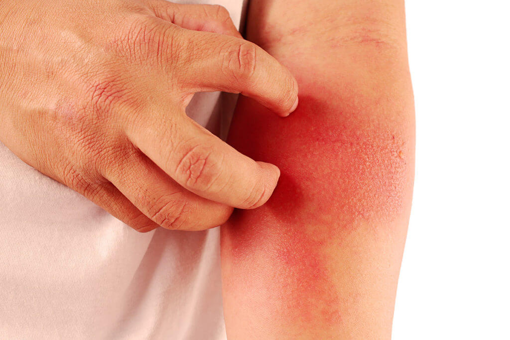 Dermatite atopique - symptômes, causes et traitement !