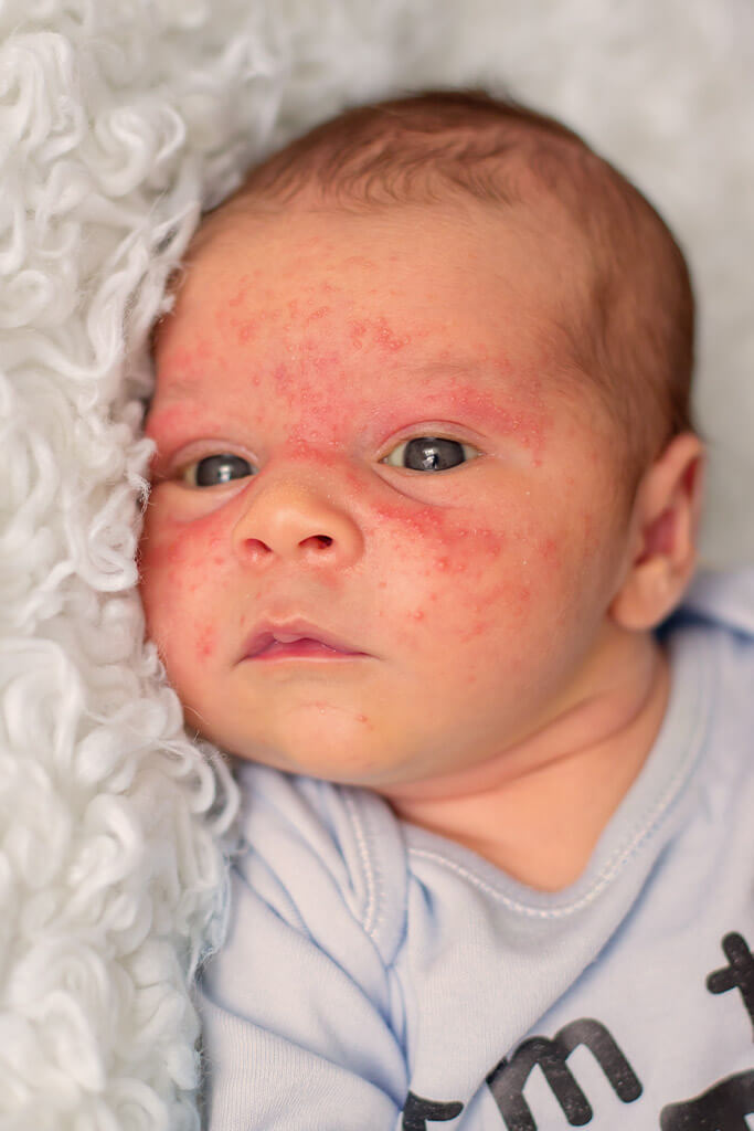 La dermatite atopique chez les bébés et les enfants