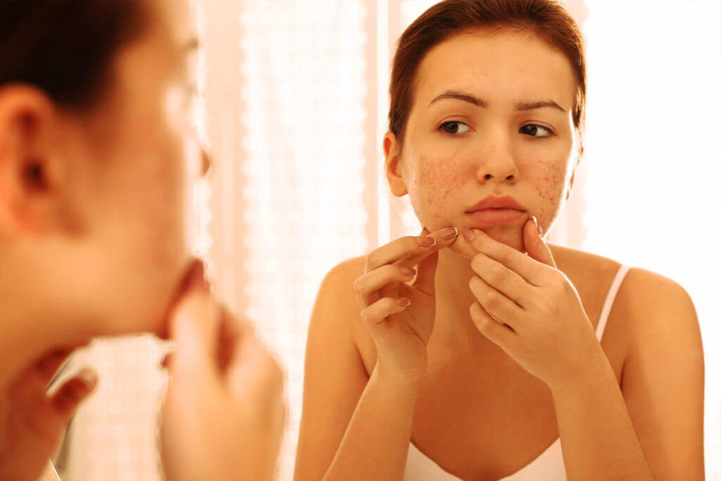 What is the difference to acne?