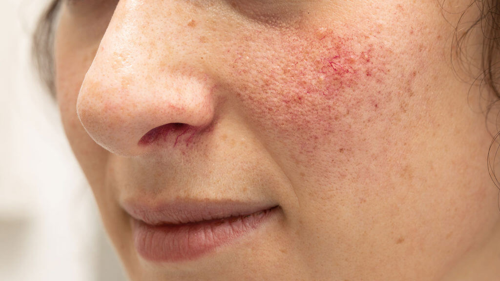 Femme avec des symptômes de rosacée sur le visage