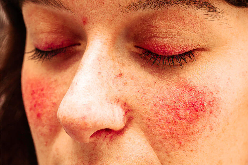 Possible triggers of rosacea