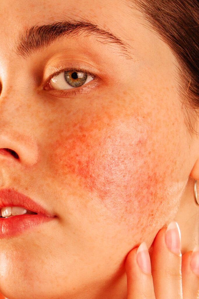 Why do you have rosacea?