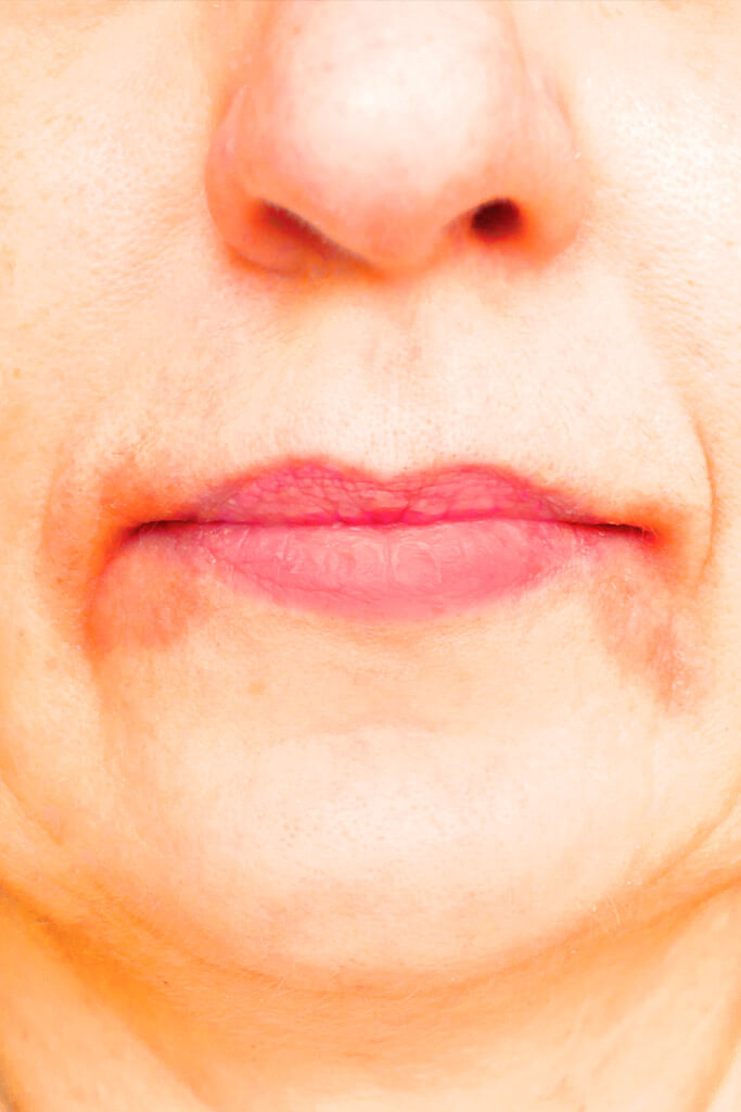 Perioral dermatitis - causes, symptoms & treatment
