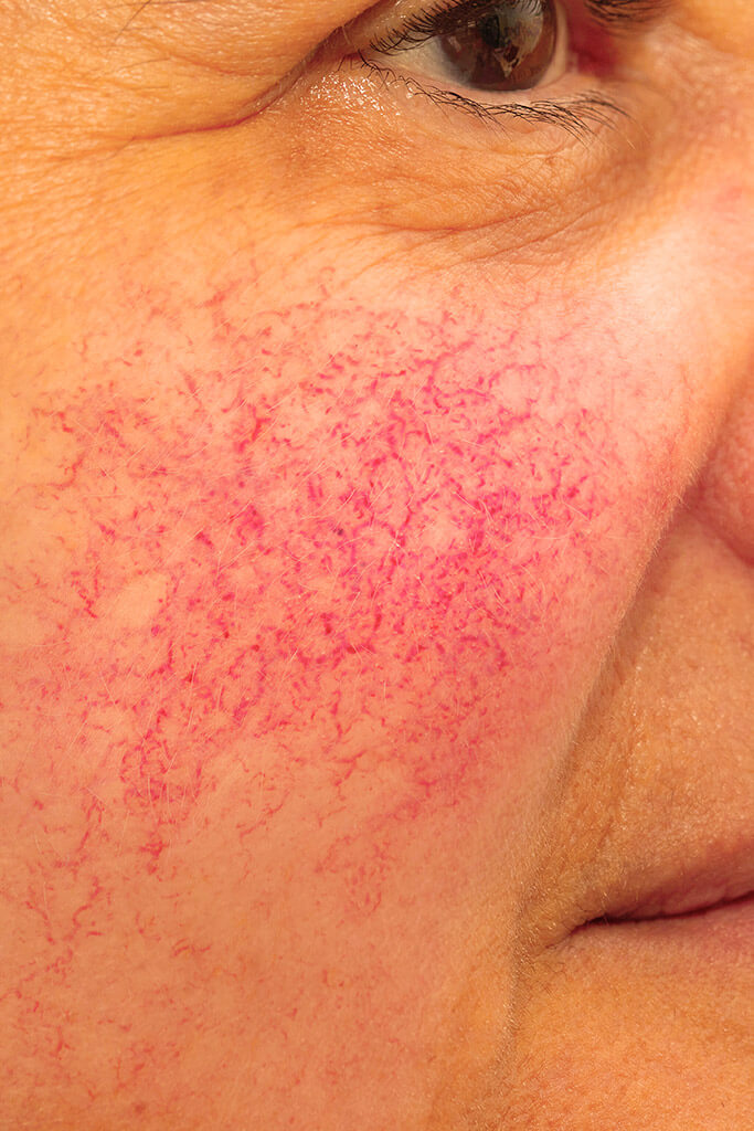 Utilisation des phages pour la rosacée