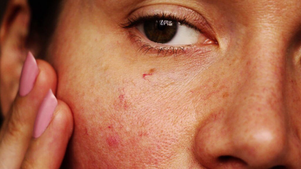 Die überpflegte Haut spannt und kann sich entzünden, wenn nichts gegen die Symptome unternommen wird.