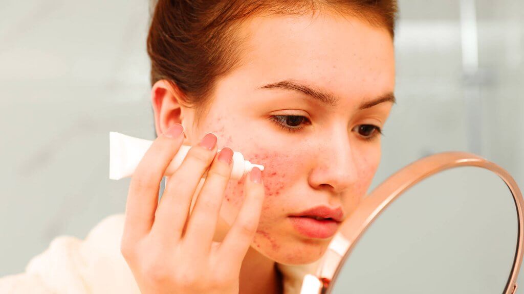 Wat bevordert een couperose-opflakkering?