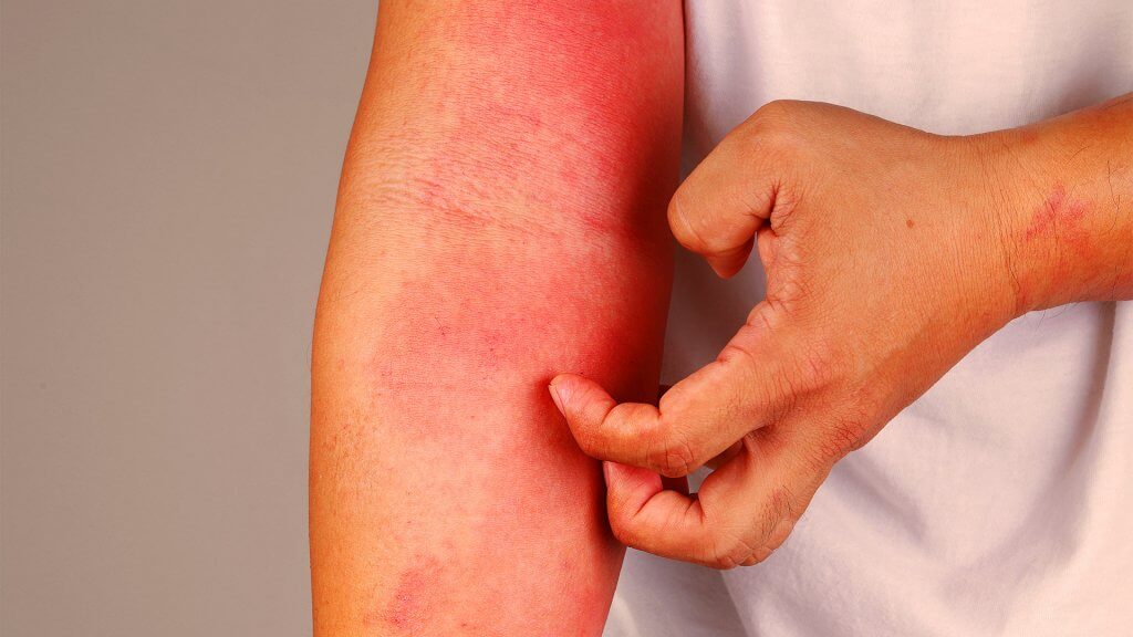 Neurodermitis als Beugeekzem am Arm