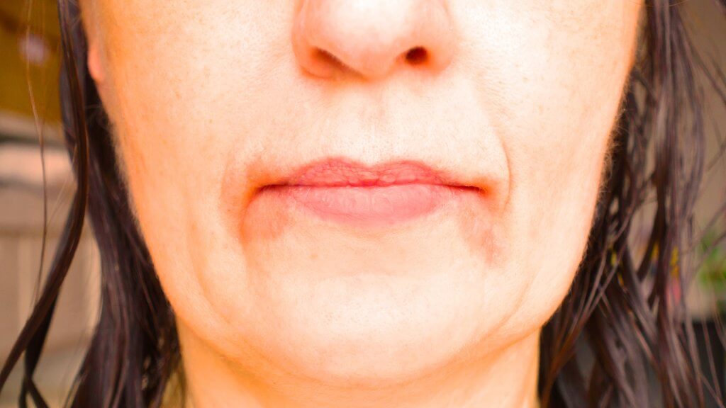 Neurodermitis um den Mund