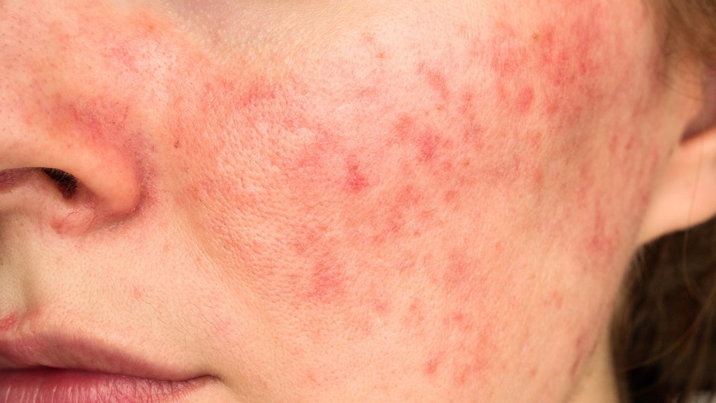 Warum ist Antibiotika bei Rosacea nicht immer sinnvoll?