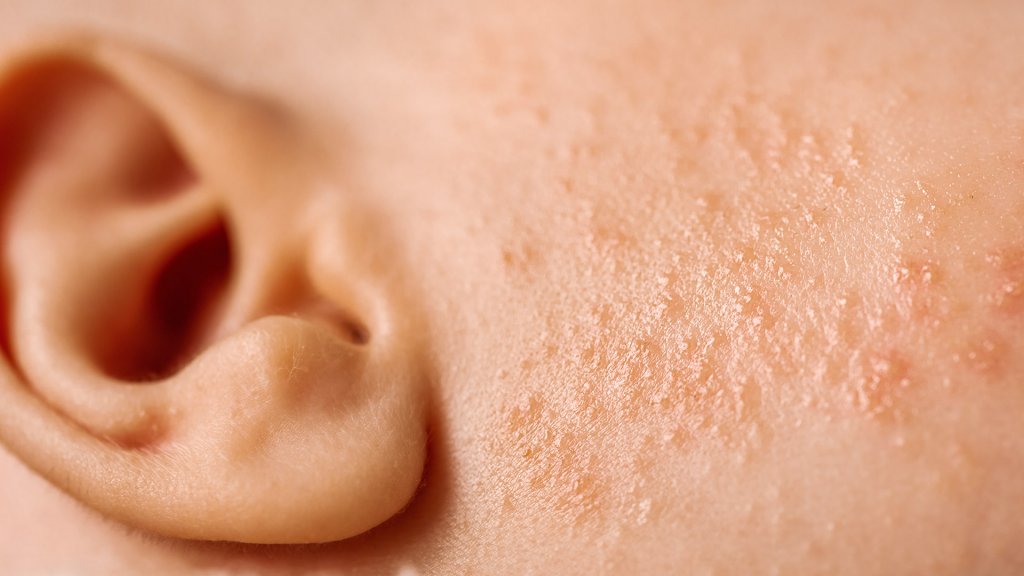 Acné de bébé - Acne neonatorum
