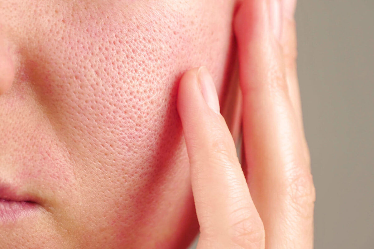 Causes des rougeurs sur le visage