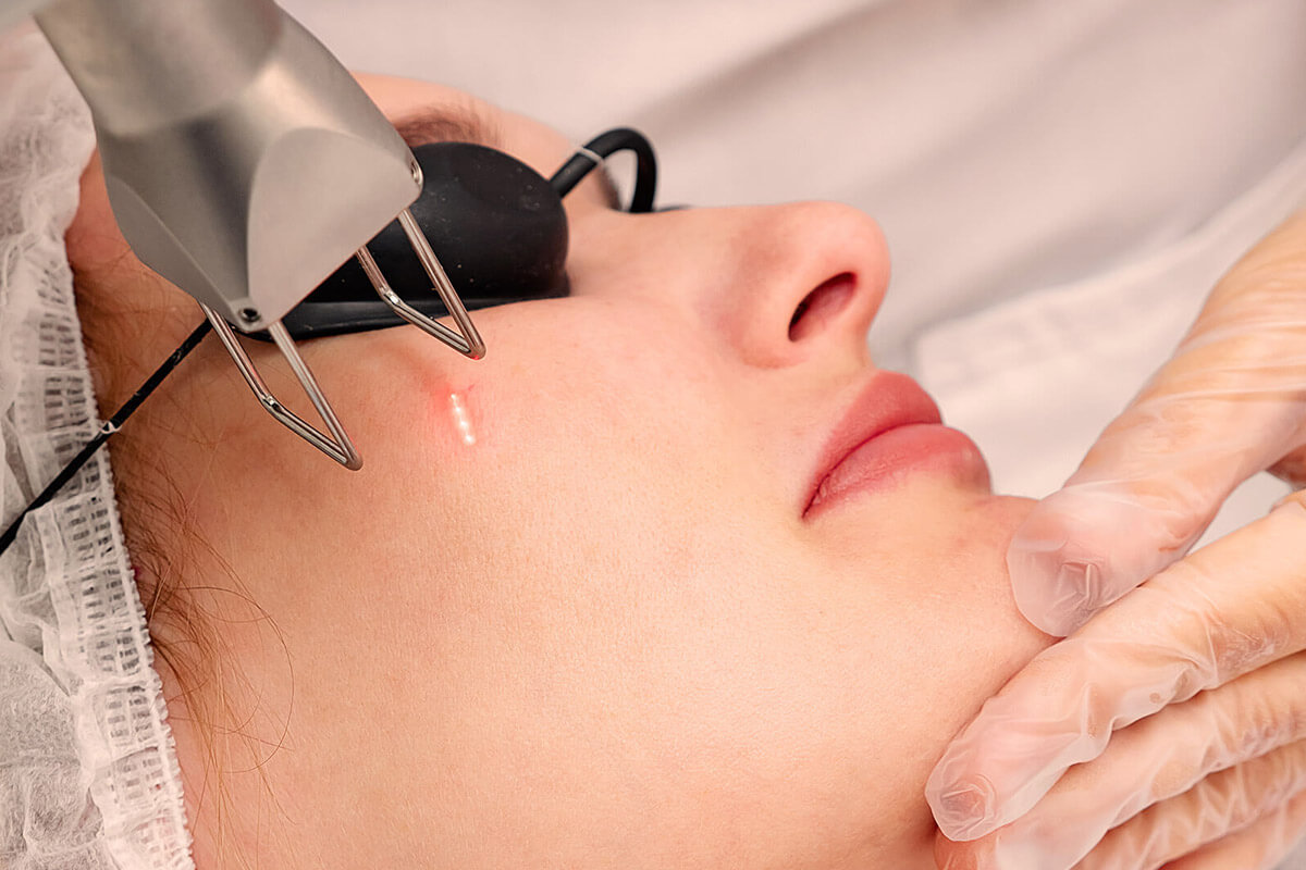 Traitement des rougeurs du visage par thérapie laser