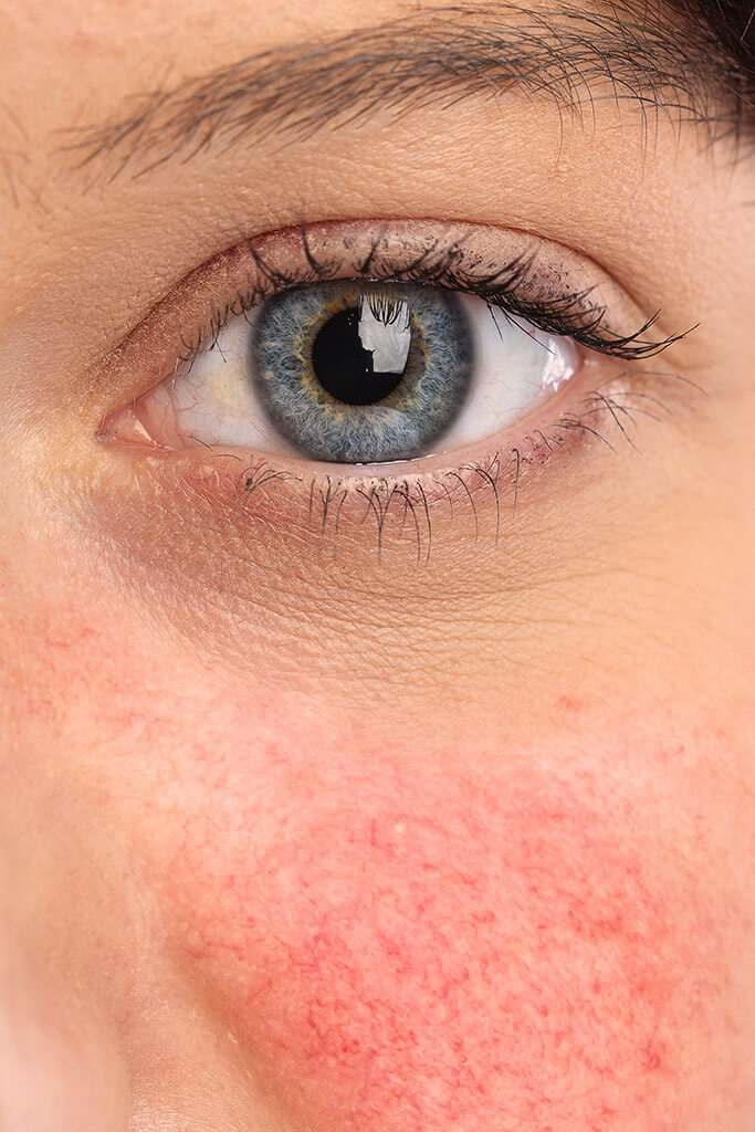 Rougeurs sur le visage - causes et possibilités de traitement