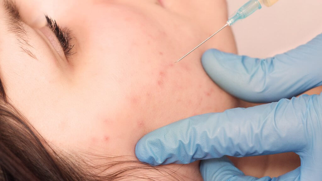 Injection de cortisone contre l'acné