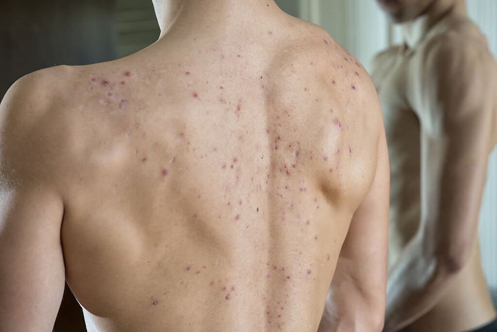 homme avec des boutons sur le dos